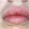 Had went to receive lip fillers in March. Left their location with a gap in my lips, to which I had to return and have them fixed. After the swelling had died down I noticed a sign